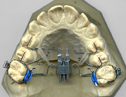Gaumenexpander auf einem oberen Gipszahnbogen, mit Metallbügeln und blauen Gummiringen, zentrierter Schraubenmechanismus zur Weitenregulierung, befestigt am Modell.