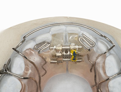 Gaumenexpander auf einem oberen Gipszahnbogen, mit Metallbügeln und blauen Gummiringen, zentrierter Schraubenmechanismus zur Weitenregulierung, befestigt am Modell.