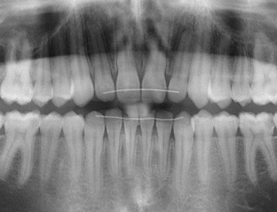 Ober- und Unterkiefer mit sichtbaren Zahnwurzeln, zwei dünnen festsitzenden Retentionsdrähten an den Frontzähnen; radiologische Darstellung von Kieferknochen und Zahnstrukturen.