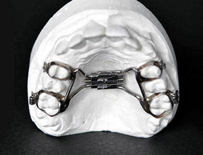 Oberkiefer-Gipsmodell mit metallischem Gaumenexpander (Palatinalexpander), an Molaren befestigt und über den Gaumen gespannt; präsentiert auf dunklem Untergrund in Laboraufnahme.