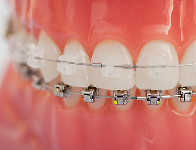 Zahnmodell trägt keramische Brackets an den oberen Schneidezähnen und metallische Brackets unten, verbunden durch Drahtbögen auf einer rosa Zahnfleisch-Prothese in Nahaufnahme.