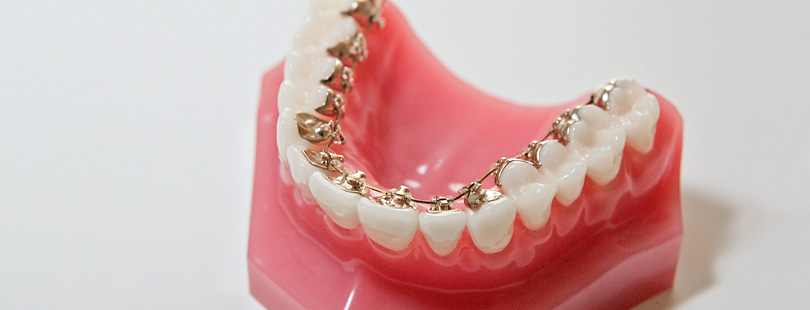 Zahnmodell mit Unterkieferzähnen trägt innenliegende Metallbrackets und Drähte, befestigt an den Zahninnenseiten, auf rosa Zahnfleischbasis vor hellem, neutralem Hintergrund.