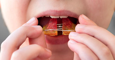 Ein Gaumenexpander wird mit den Fingern an den oberen Schneidezähnen gehalten und in den Mund eingesetzt; die Lippen sind leicht geöffnet, Hände und Zähne im Nahbereich, unscharfer Hintergrund.